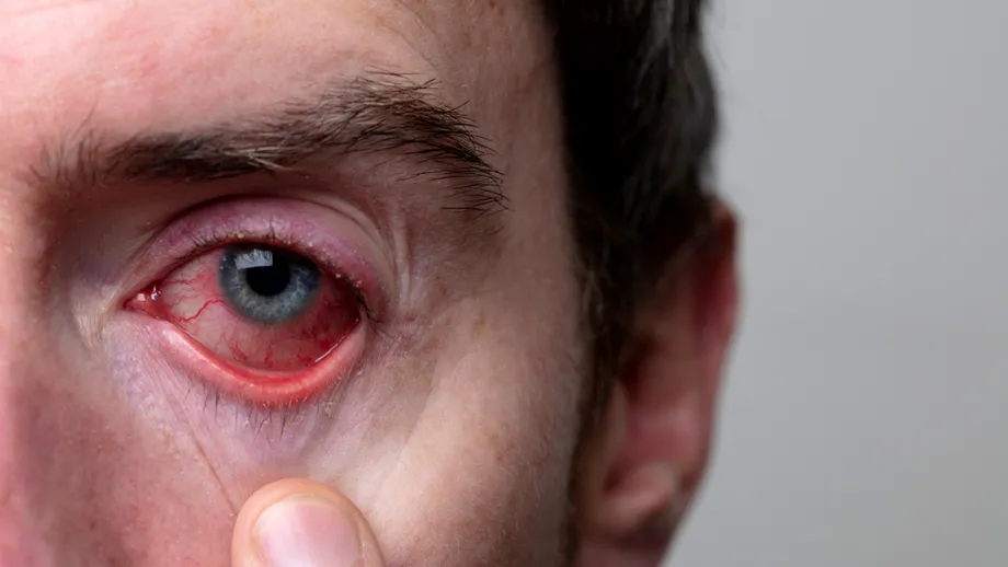 Semnul din ochi care indică cele mai periculoase infecții cu transmitere sexuală. Așa descoperi dacă te-a înșelat!