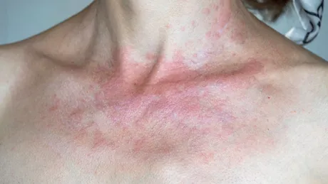 Ce boli de piele sunt declanșate sau agravate de expunerea prelungită la soare