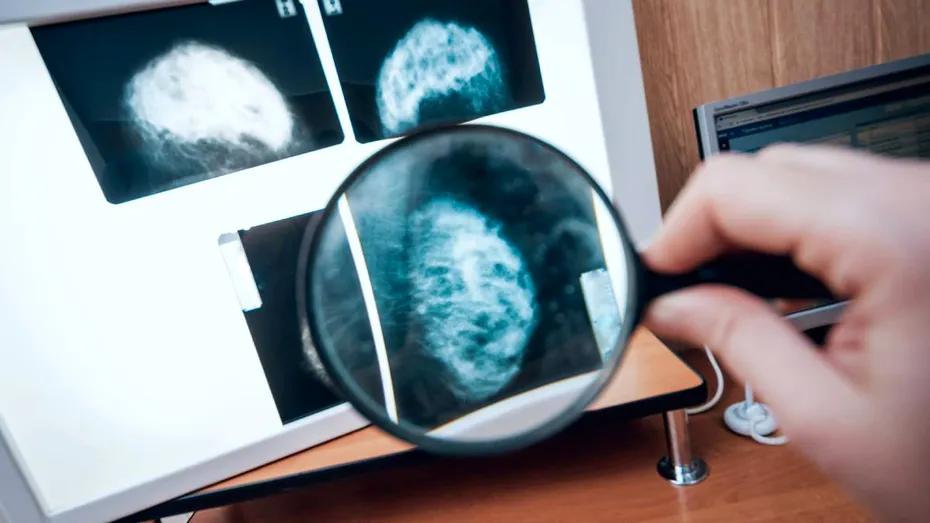 14 mituri și adevăruri despre cancerul mamar