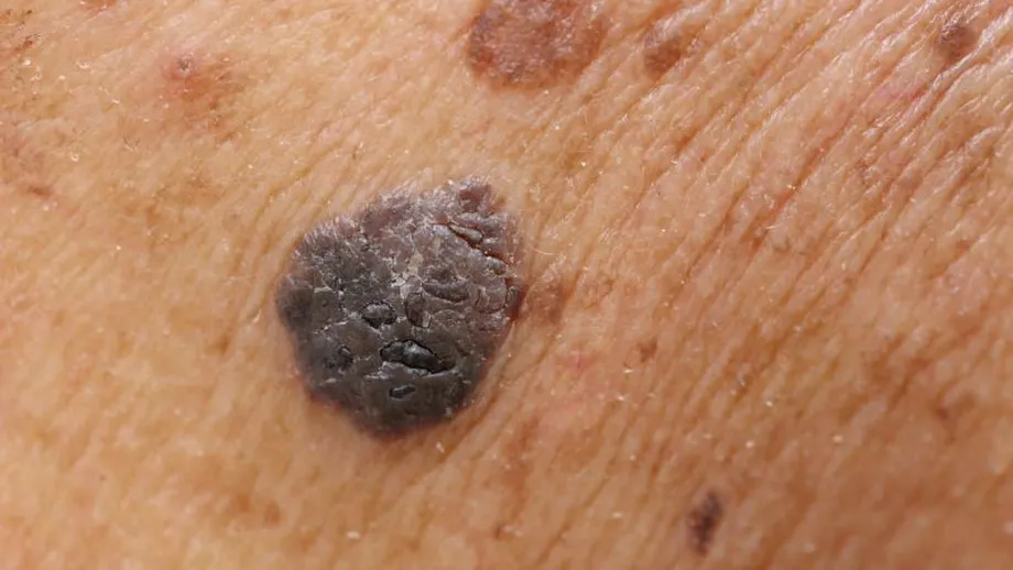 Un nou medicament ar putea reduce cu 90%  răspândirea melanomului