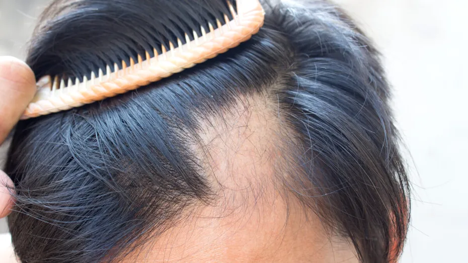 Părul tău merită mai mult: Dr. Diana Savu explică tot ce trebuie să știi despre alopecie și prevenție