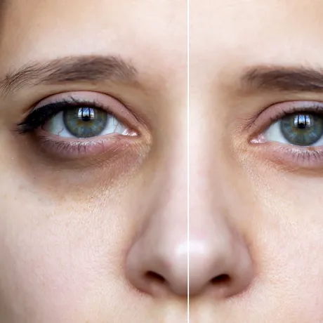 Cum să scapi peste noapte de cearcăne. Spune adio ochilor umflați