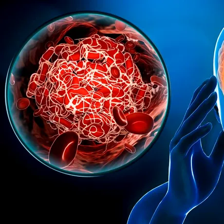 Cum să recunoști simptomele unui accident vascular cerebral:  sfaturile neurologului