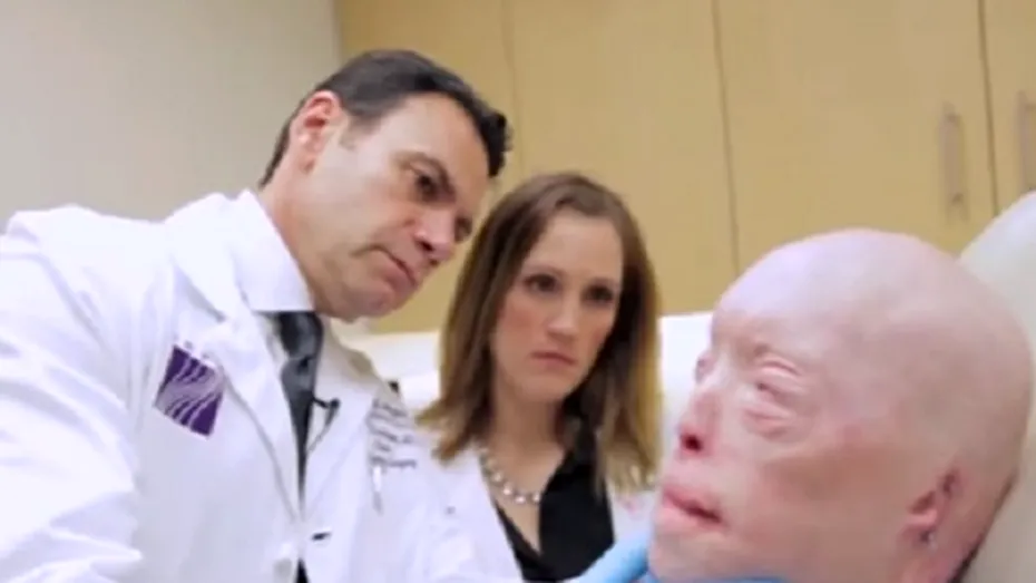 Cum arată acum bărbatul care a trecut prin primul transplant de faţă complet