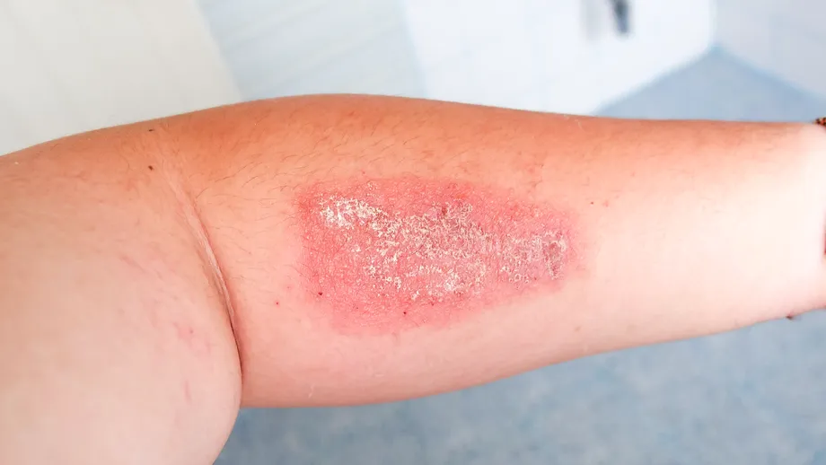 De la locul de joacă, la lenjeria din hotel. Cele mai banale locuri în care se poate transmite stafilococul auriu