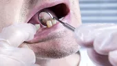 Cum poate fi prevenită boala parodontală, cea mai gravă și răspândită boală a danturii care duce la pierderea dinților