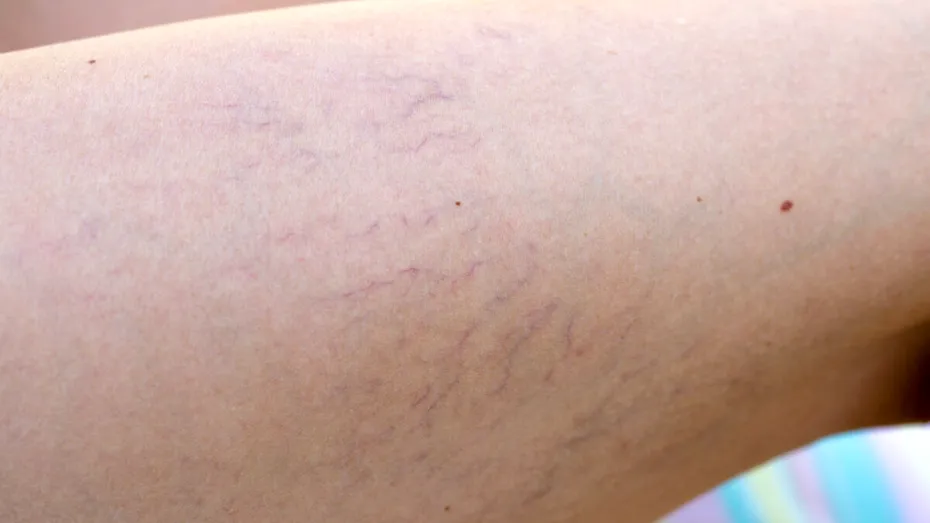 De ce NU trebuie să ignori venele sparte de pe picioare