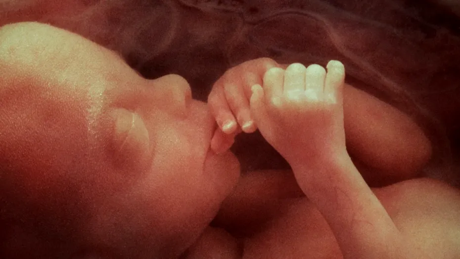 Caz extrem de rar. Un fetus a fost extras din creierul unei fetițe de un an care nu putea să stea în șezut și avea circumferința craniană mărită