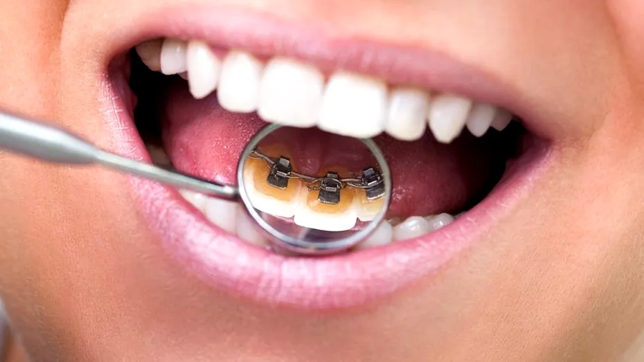 Tipuri de aparate dentare: ţie care ţi se potriveşte?