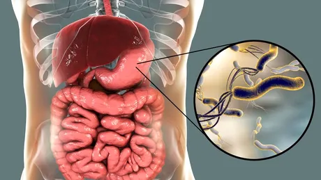 Helicobacter pylori, bacteria care îmbolnăveşte stomacul a milioane de români
