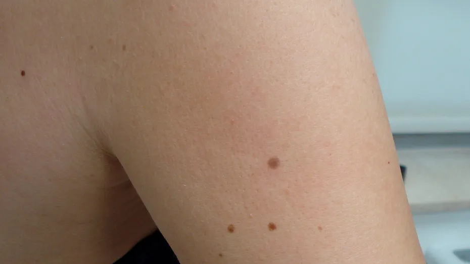 Alunițe normale sau alunițe cancerigene – principalele diferențe