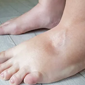 Corpul tău pare umflat fără motiv: adevărul despre retenția de apă