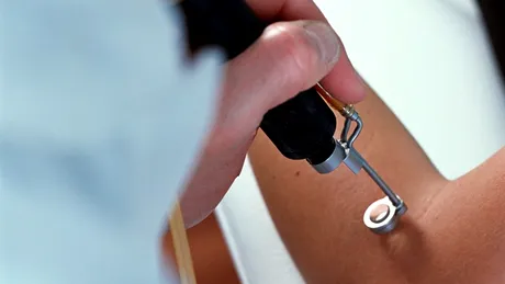 Epilarea definitivă cu laser: o creştere cu 25% în rândul bărbaţilor din România