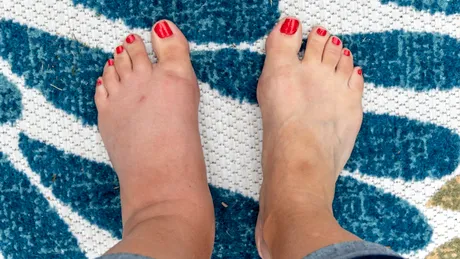 Semnele ascunse de pe picioare care pot indica probleme grave de sănătate. La ce trebuie să fii atent