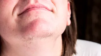 De ce crește părul în barbă la femei. Bolile vinovate pentru părul facial, înainte sau după menopauză