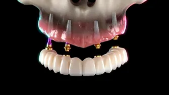 (P) Ai dinți lipsă sau porți o proteză mobilă? Află cum poți avea dinți ficși în 24 de ore