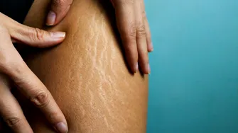 Ce să aplici pe piele să reduci vergeturile. 3 ingrediente de succes recomandate de dermatolog