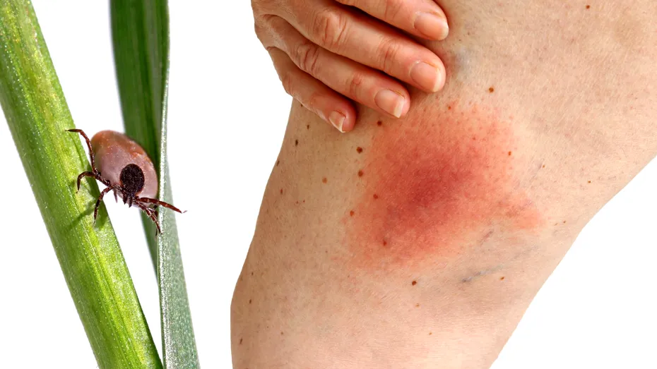 Cum arată mușcătura de căpușă. Semnele care o deosebesc de înțepătura de țânțar