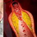 Ai observat aceste schimbări la ochi sau picioare? Pot avea legătură cu colesterolul
