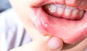 Aftele bucale – ce vitamine și minerale îți lipsesc dacă ai des această problemă