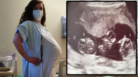 Ce a născut femeia din imagine, de fapt. Acest lucru rar se întâmplă o dată la 200.000.000 de cazuri