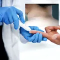 Medicii avertizează: o pată închisă la culoare pe piele poate fi un semn al diabetului de tip 2