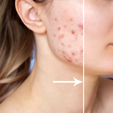 Scapă de coșuri și curăță porii cu un produs din congelator. Cum funcționează trucul magic