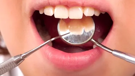10 mituri despre plombe dentare şi carii
