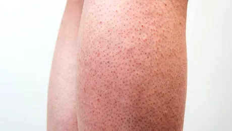 Strawberry legs - 3 cauze și tratament pentru piele „de căpșună” pe picioare